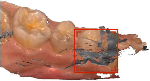 Shining 3D Aoralscan 2