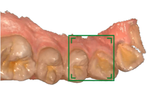 Shining 3D Aoralscan 2